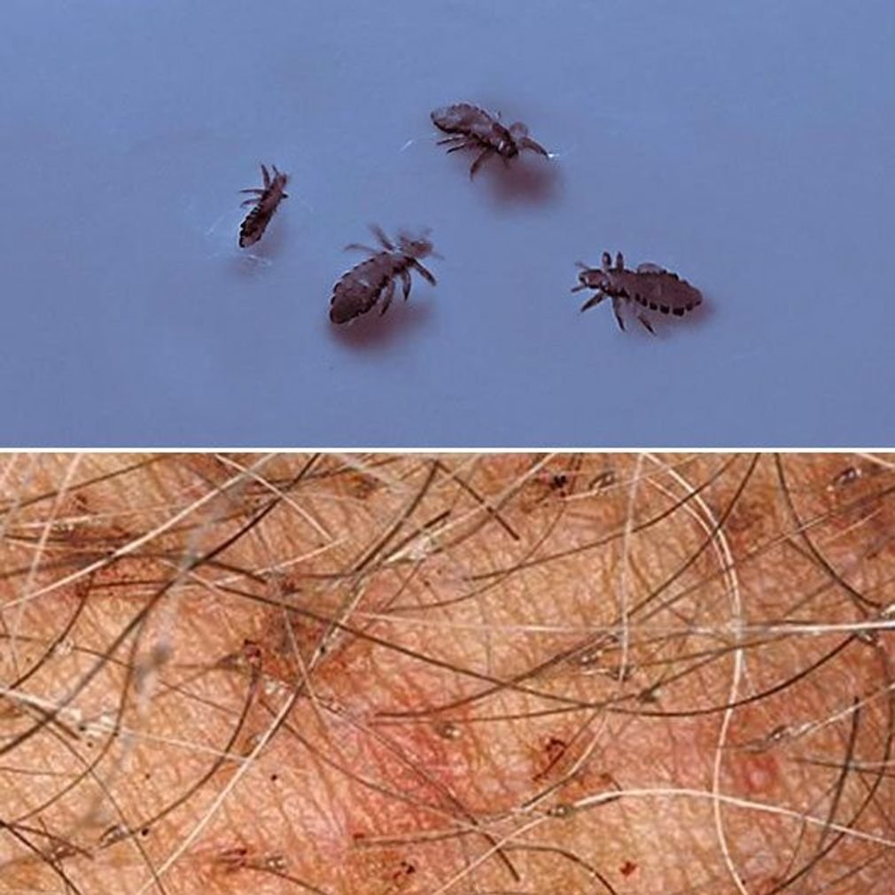 Вошь человеческая фото