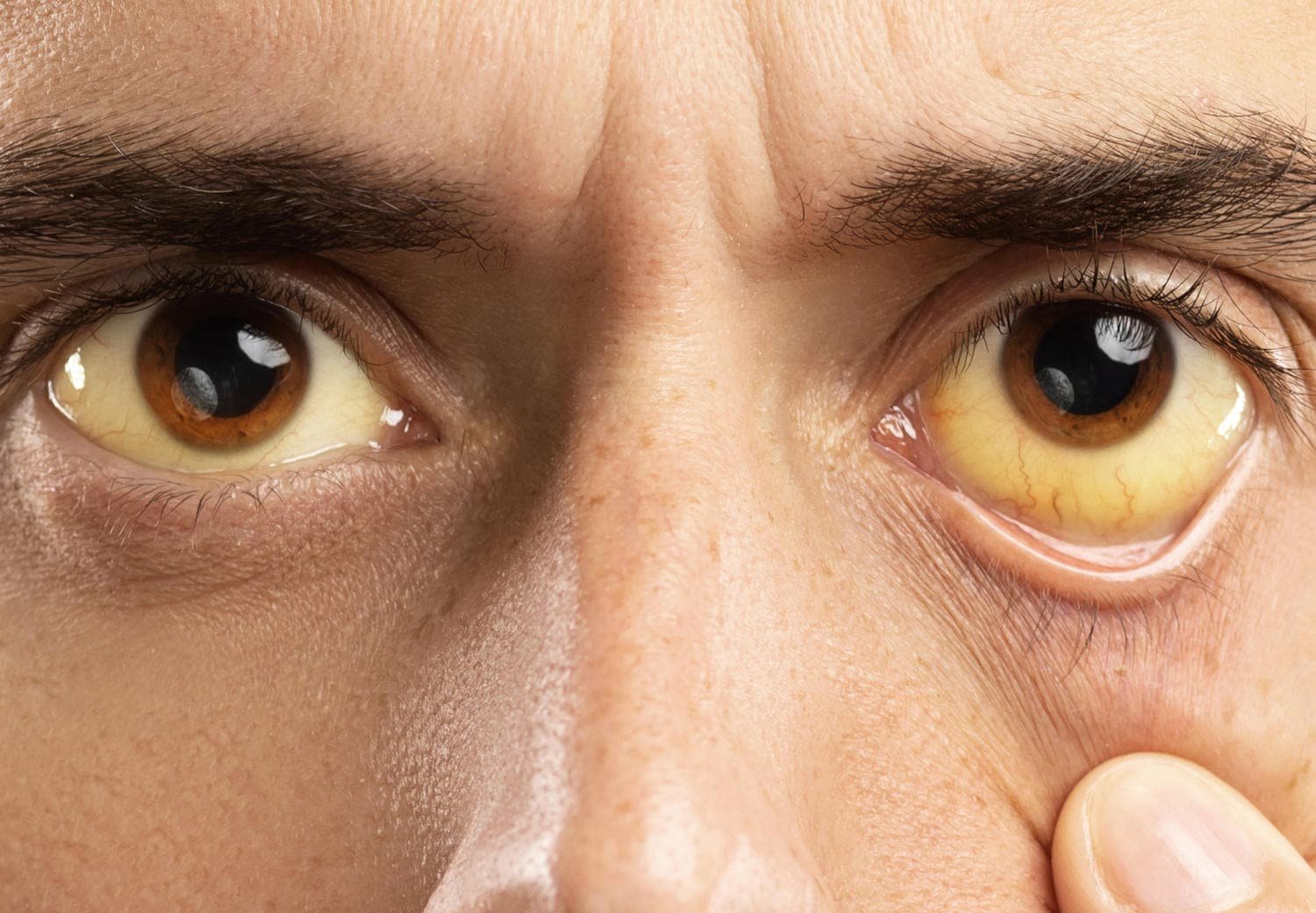 Описание желтых глаз. Пожелтение склер гепатит. Желтые глаза.
