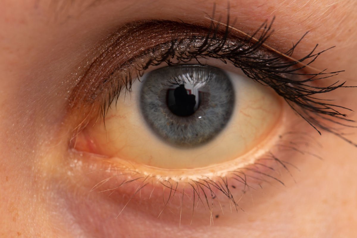 Сухой глаз с желтизной