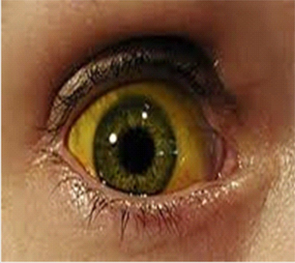 Склеры глаз при гепатите