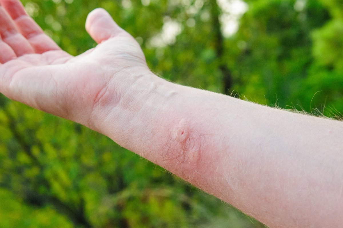 Смайлик аллергия