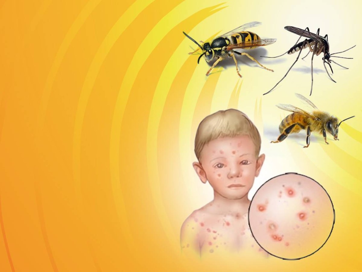 Укусы насекомых картинки для презентации