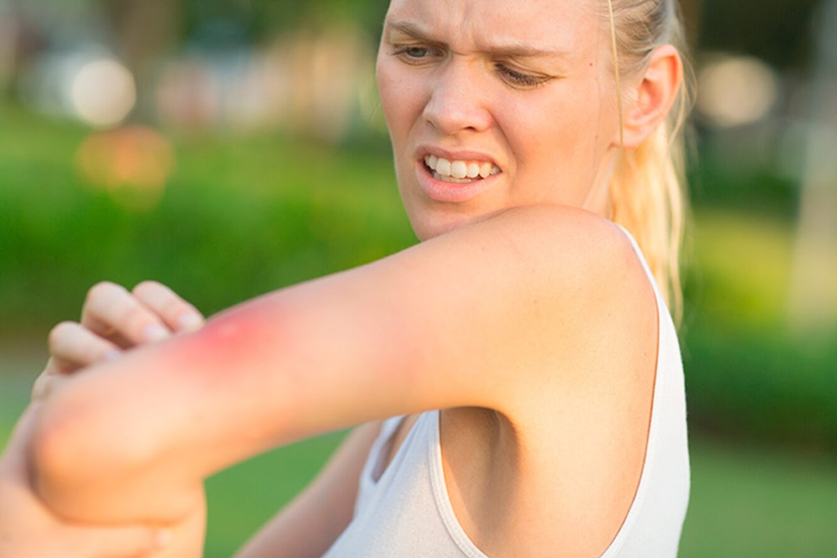 Прыщи от укусов насекомых