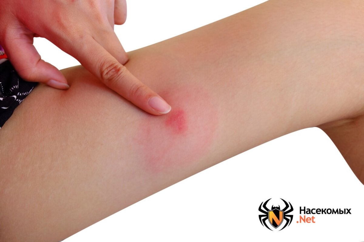 Укусы насекомых для дошкольников