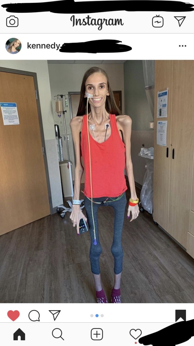 Лера Кошкина анорексия