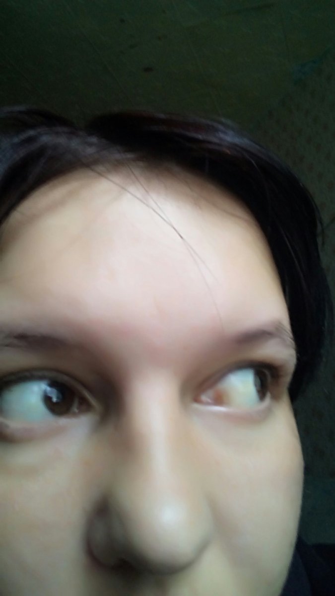 Алкогольный гепатит желтушность