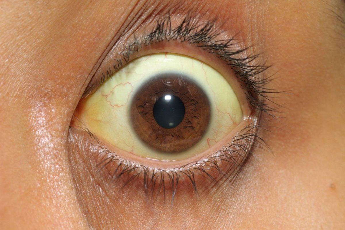 Пожелтение склер гепатит