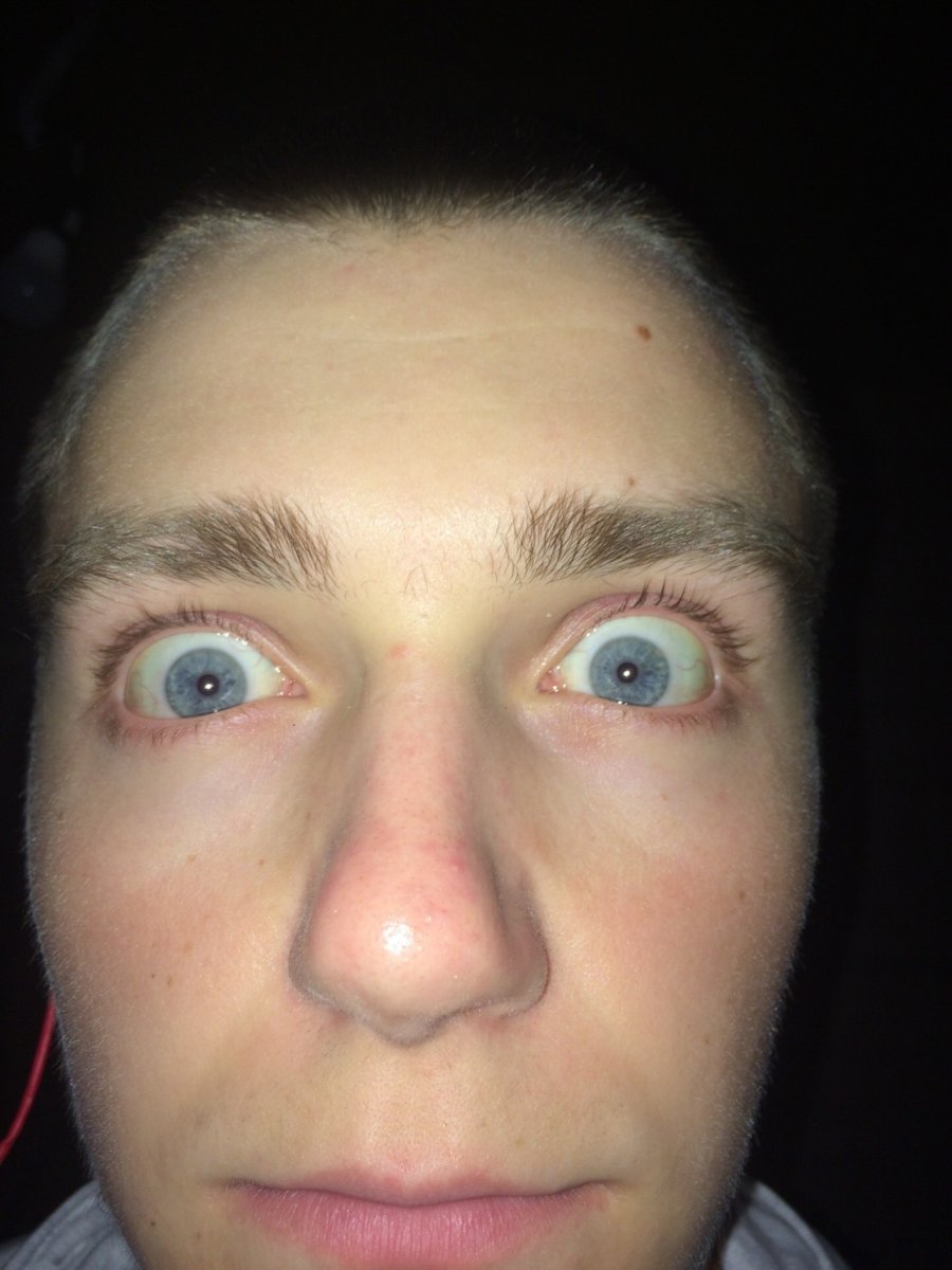 Желтоватый оттенок глаз