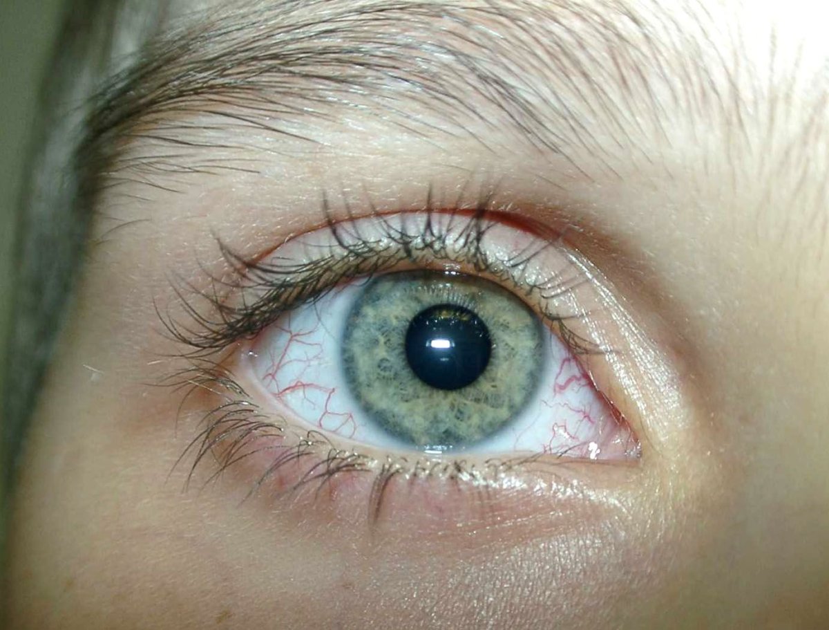 Желтушность кожи и склер