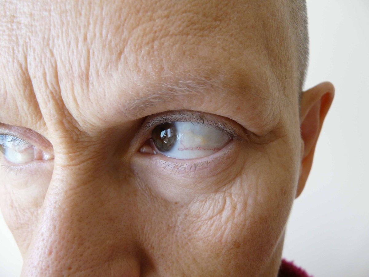 Желтушность склер гепатит