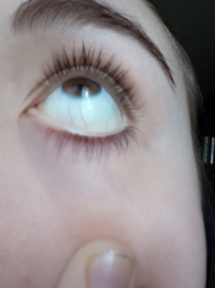 Синдром Жильбера склеры