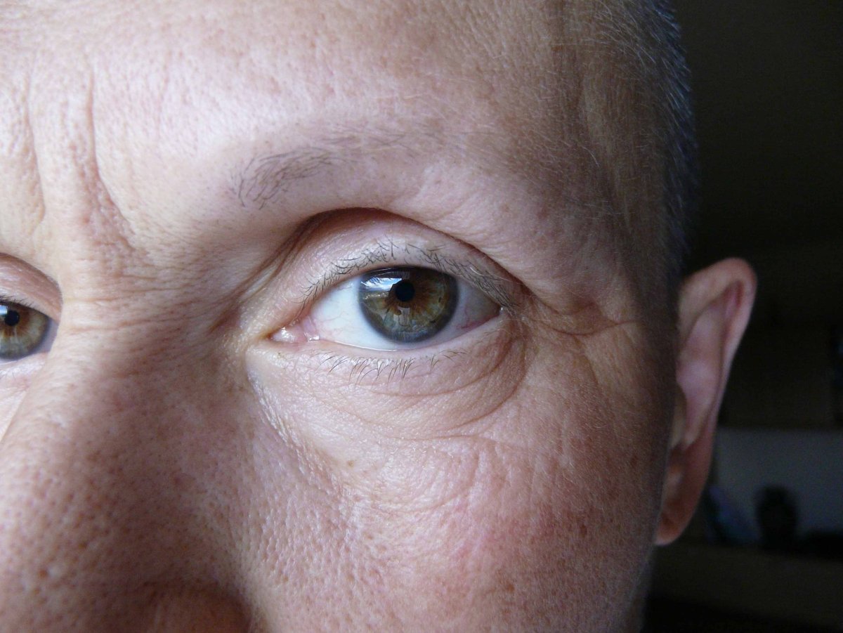 Пожелтение белков глаз