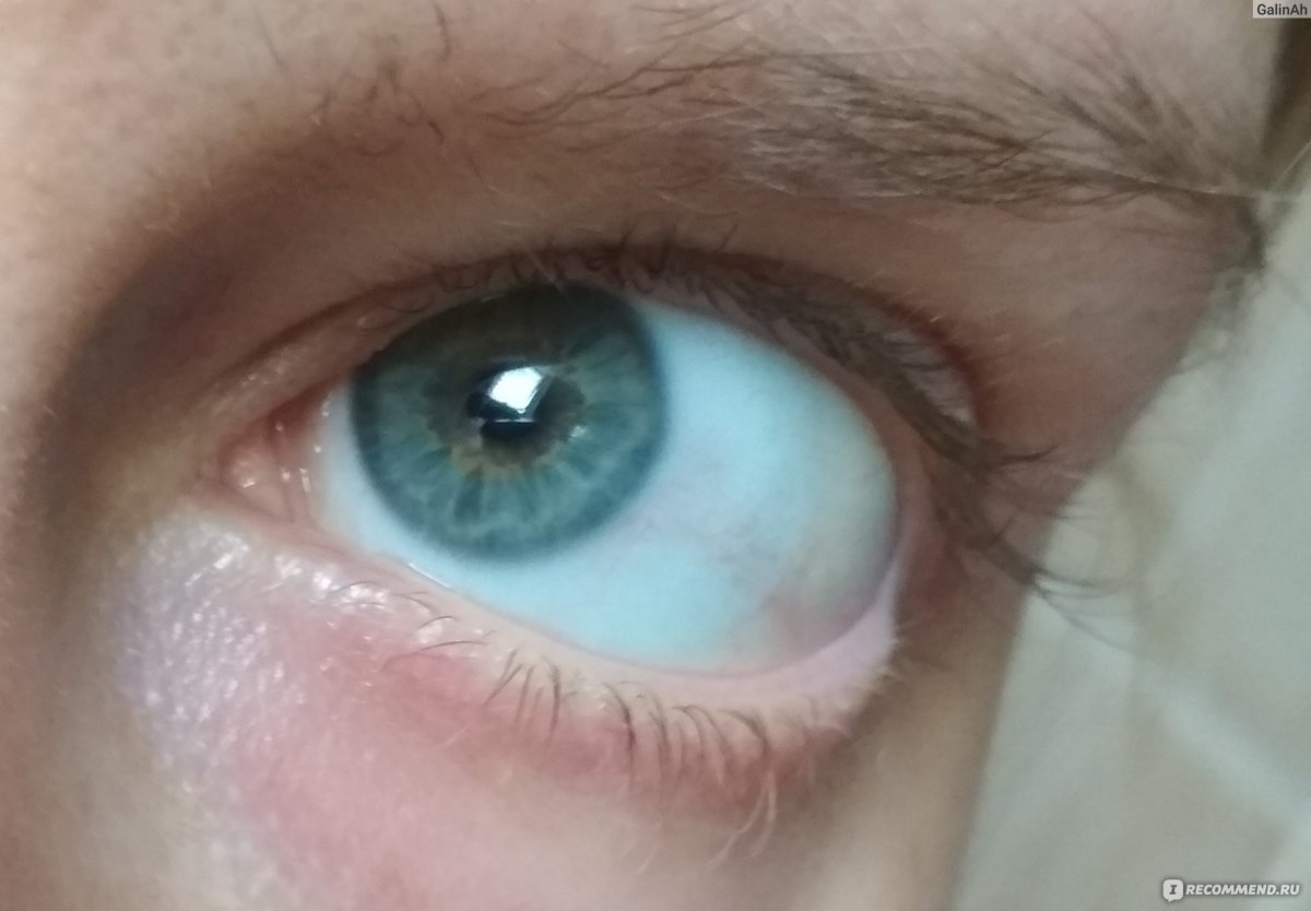 Пингвекула коньюктивита