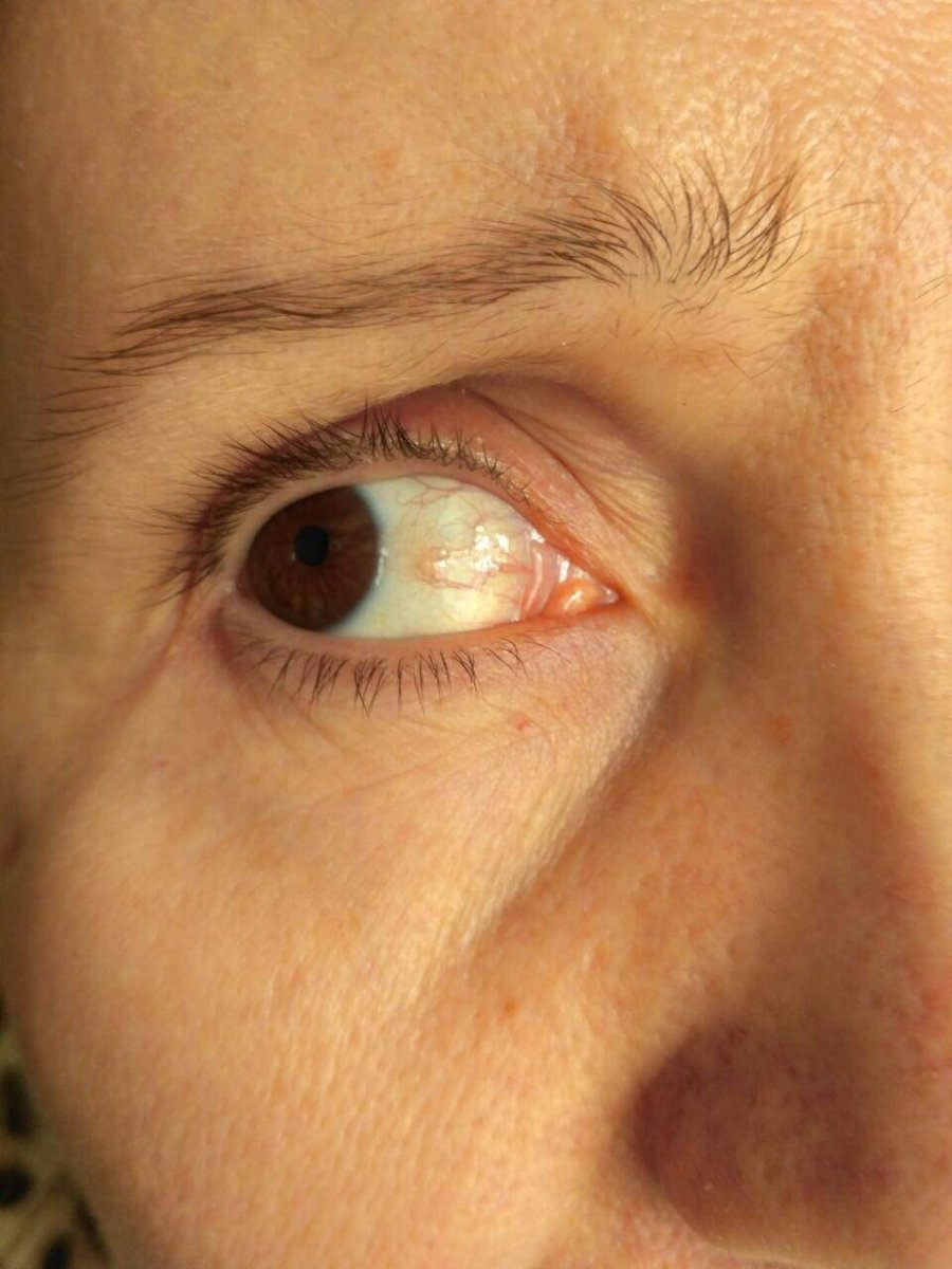 Отслоение сетчатки глаза у кошки