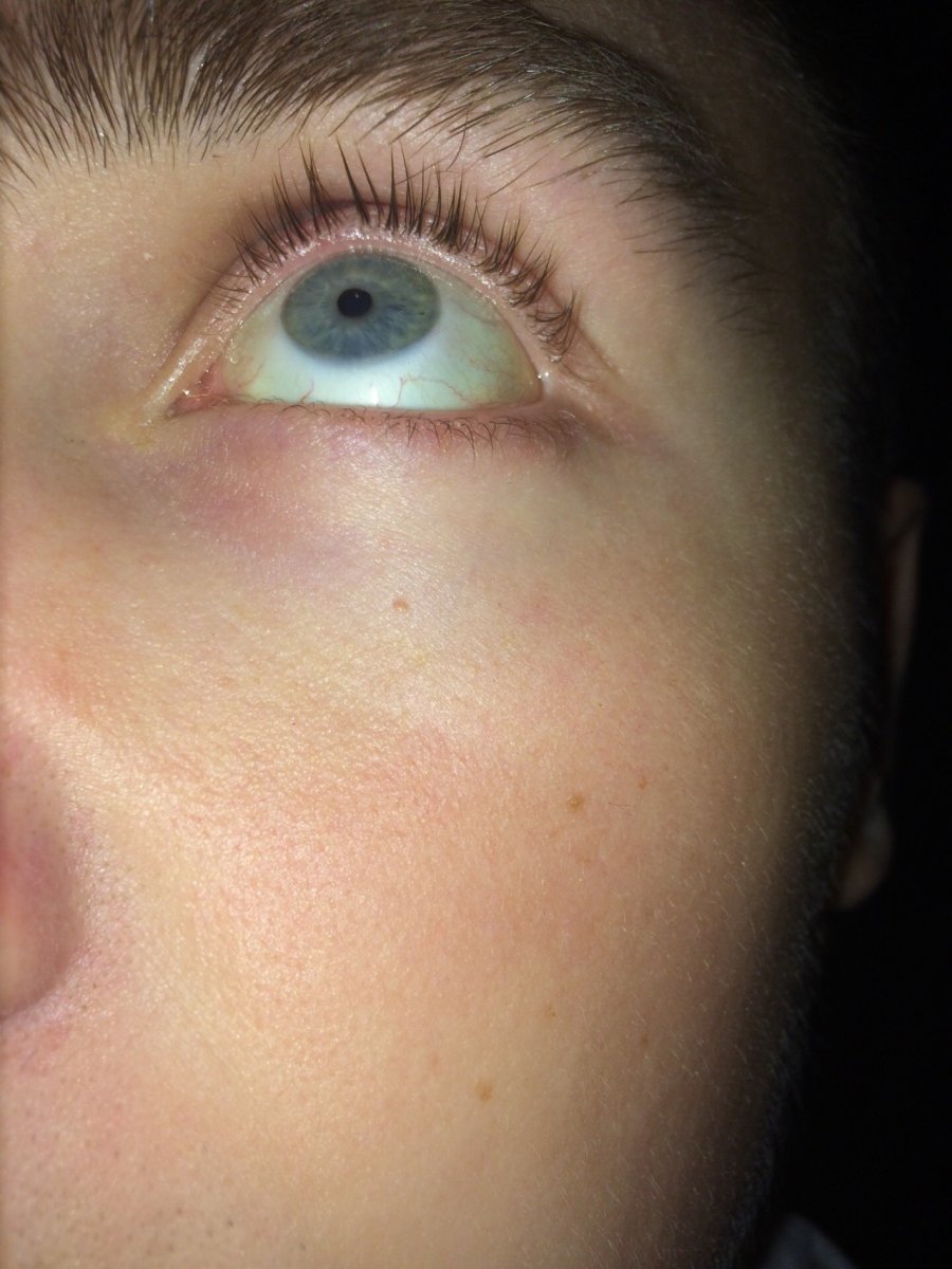 Arcus senilis - сенильная дуга роговицы