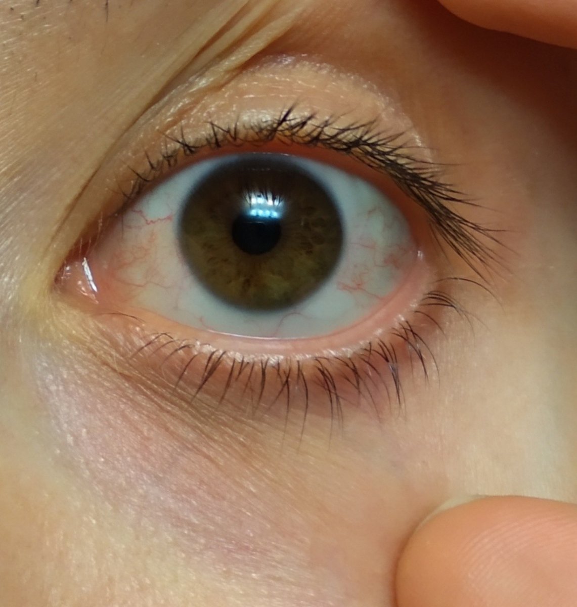 Телеангиэктазия склеры