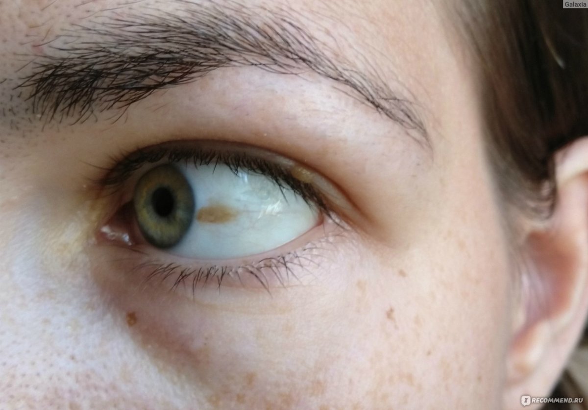 Субконьнктивальное кровоиз