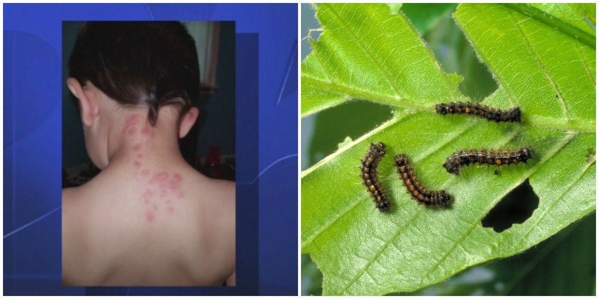 Укусы гусеницы непарного шелкопряда