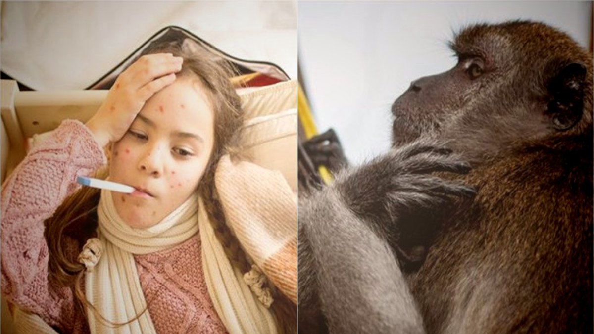 Обезьянья Обезьянья оспа