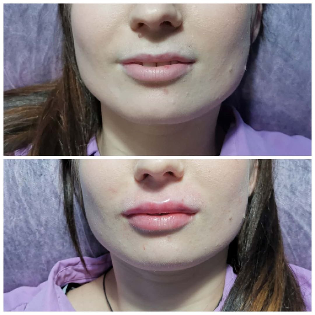 Фейсбилдинг для губ