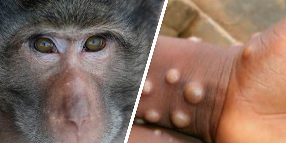 Обезьянья обезьяня оспа